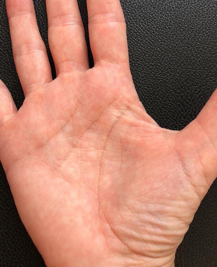 Psoriasis an der Hand