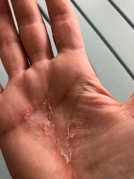 Psoriasis an der Hand