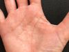 Psoriasis an der Hand