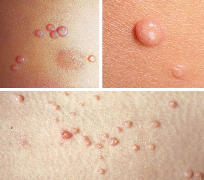 Molluscum contagiosum