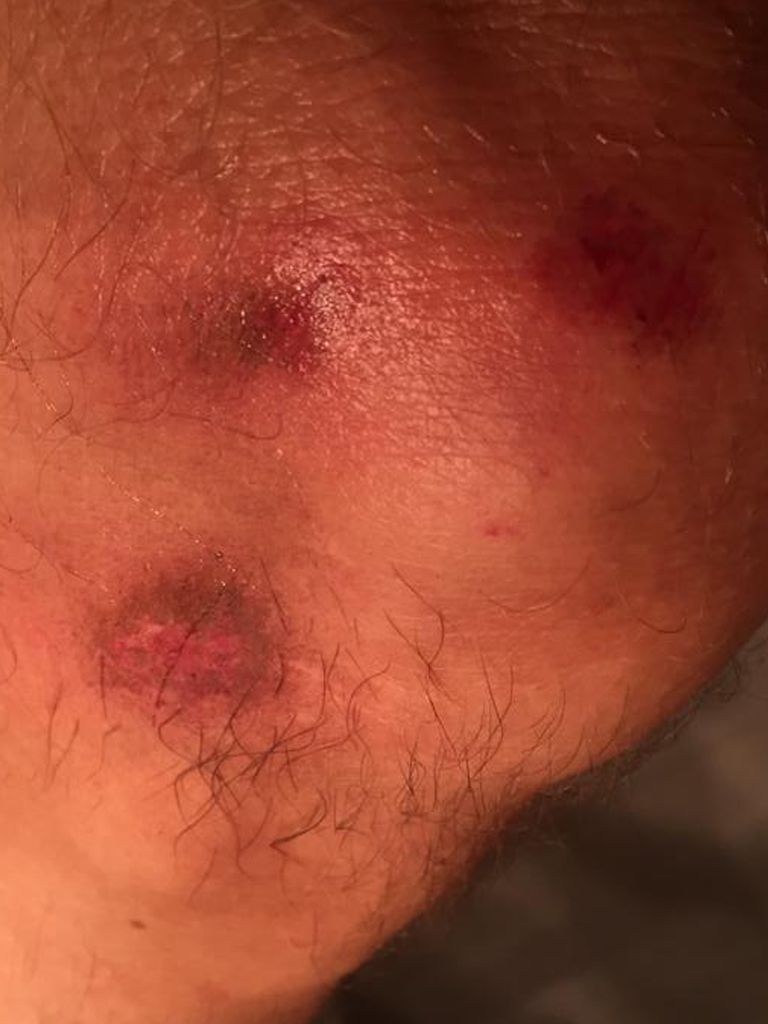 Schürfwunde am Knie mit DermaSilk behandelt